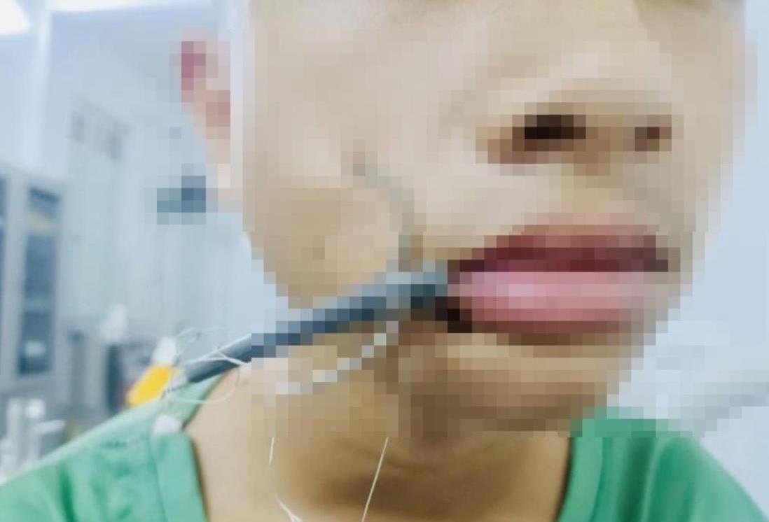 Cấp cứu thiếu niên bị lưỡi câu găm vào má