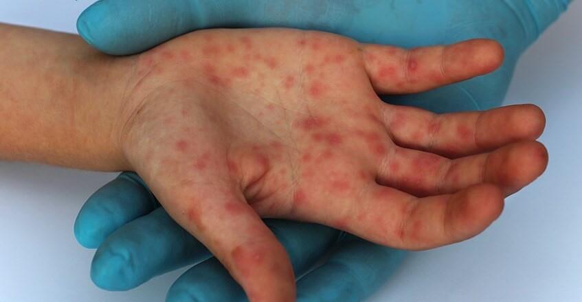 Bệnh nhân có phát ban cấp tính dạng mụn nước hoặc mụn mủ là biểu hiện của bệnh Mpox.