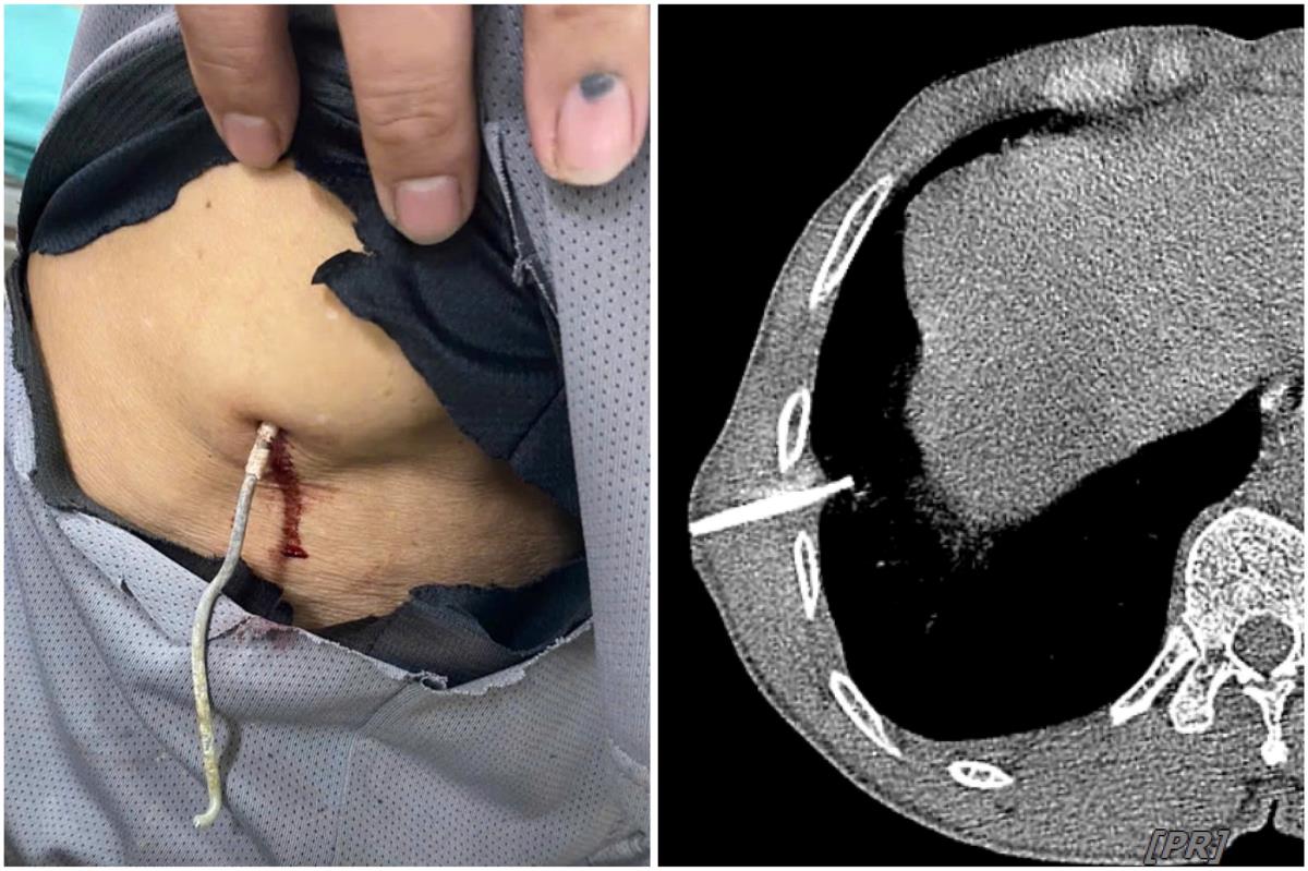 Sau 4 ngày phẫu thuật và điều trị, sức khỏe bệnh nhân đã ổn định.