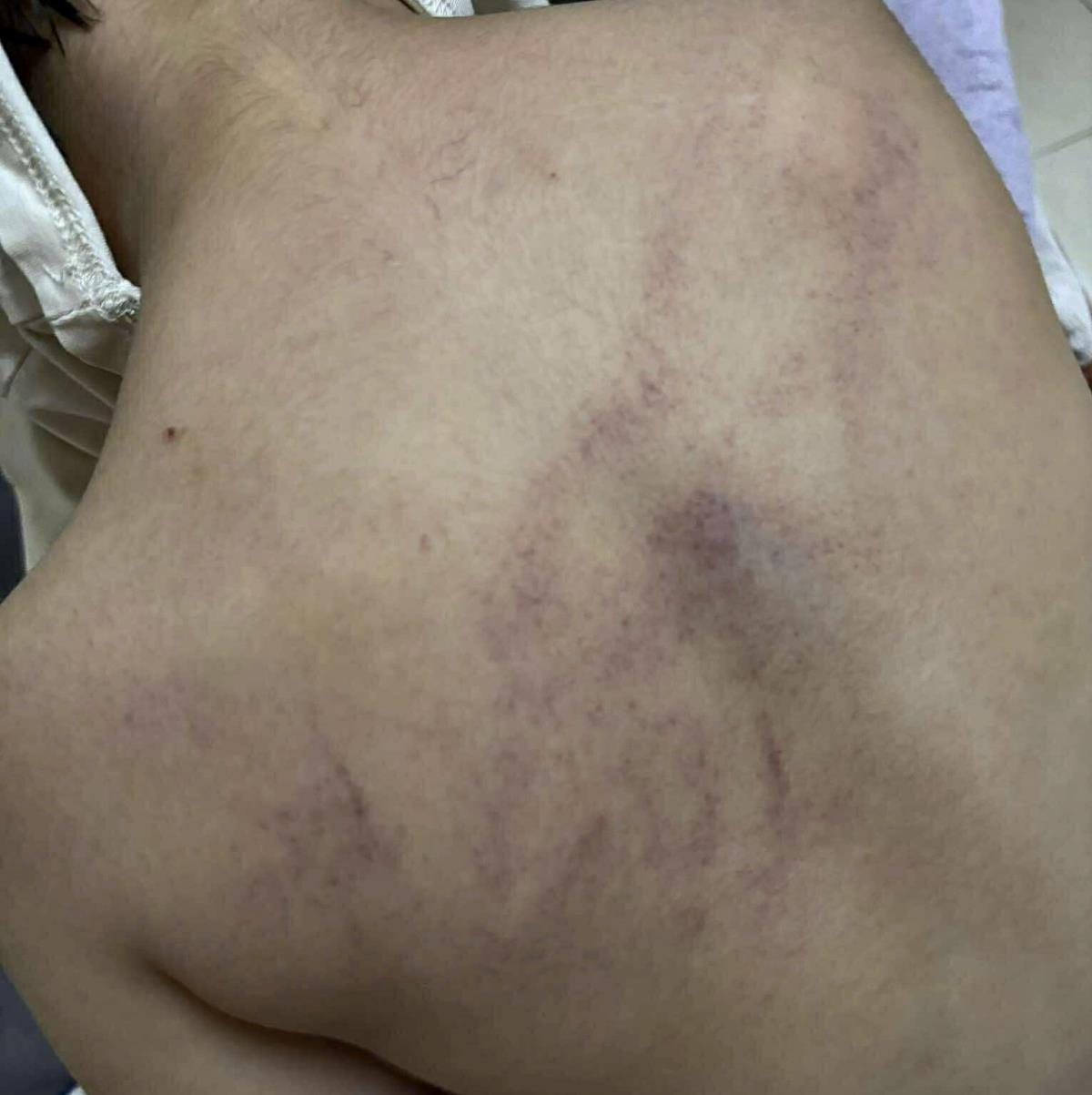 Các vết bầm tím trên cơ thể của bé gái 4 tuổi nghi bị giáo viên bạo hành. Ảnh: Gia đình cung cấp