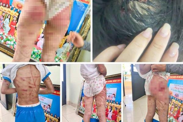 Bắt người cha dượng bạo hành con riêng của vợ để điều tra về hành vi Cố ý gây thương tích