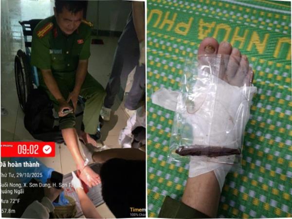 Thượng tá Công an bị gỗ đâm xuyên bàn chân khi hỗ trợ người dân