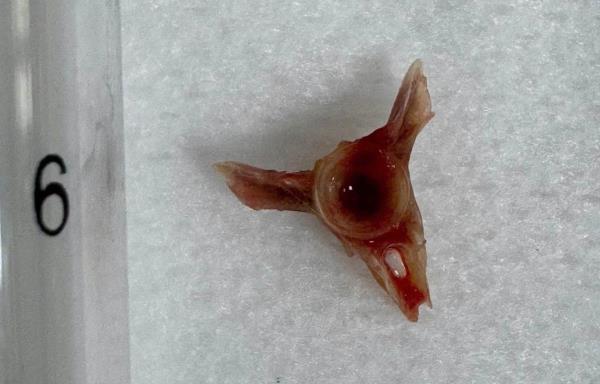 Rùng mình mảnh xương cá hình spinner găm trong phế quản bệnh nhân hơn 5 tháng trời