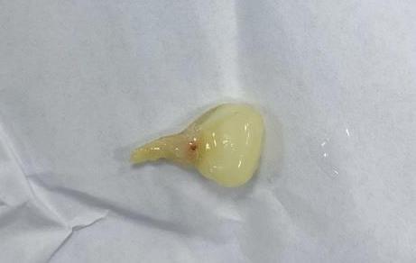 Cấp cứu vì hạt bắp