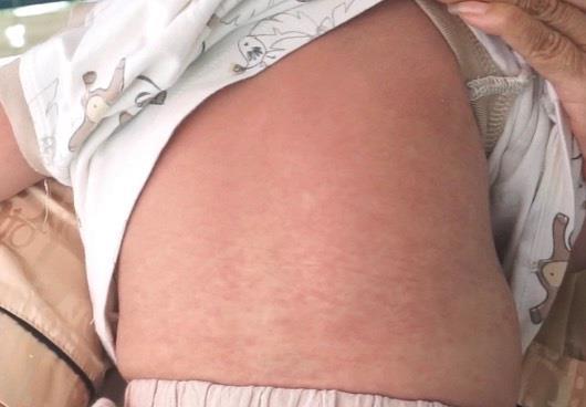 TP Hồ Chí Minh ghi nhận 3 trường hợp tử vong do sởi