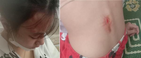 Điều tra vụ nữ sinh lớp 10 bị đánh chấn động não
