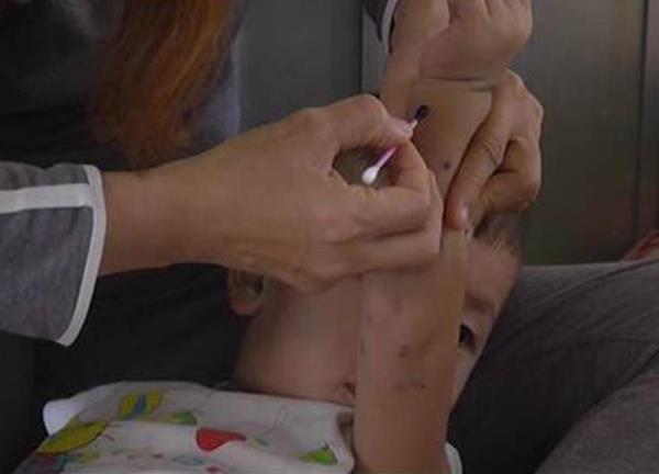 Khẩn trương ứng phó bệnh tay chân miệng