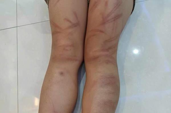 Nghệ An: Tạm đình chỉ giáo viên quản lý lớp vụ trẻ mầm non bị đánh