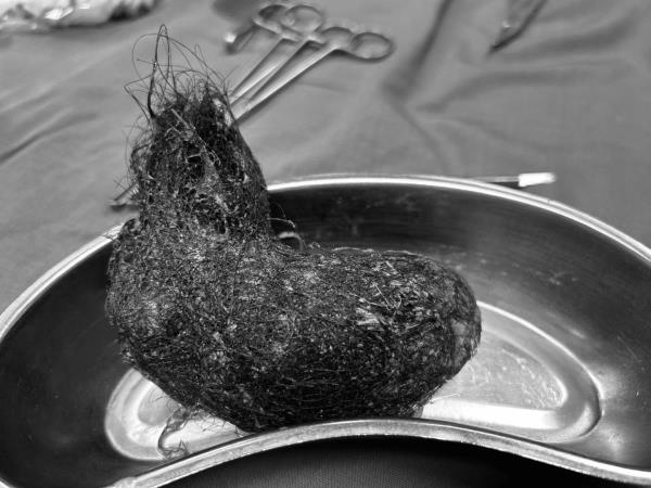 Phẫu thuật thành công ca lấy búi tóc lớn trong dạ dày bệnh nhi 7 tuổi