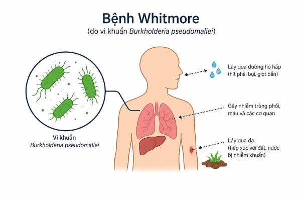 Gia Lai ghi nhận ca nhiễm bệnh Whitmore đầu tiên trong năm 2026