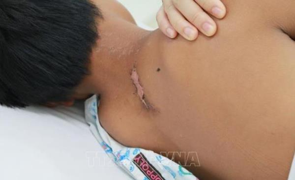 Cứu sống bé trai ngưng thở, ngưng tim 30 phút do bị sét đánh