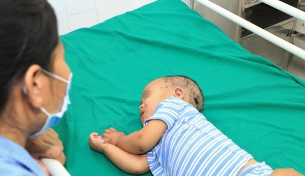 Nghệ An: Nhiều trẻ nhỏ nguy kịch phải cấp cứu do bị ong đốt